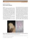 Filler‐induced alopecia