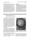 Female pattern baldness in men
