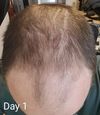 Male - 30s - male pattern baldness - Oral 2.5mg min - 1mg Fin