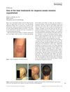 One of the best treatments for alopecia areata remains unpublished