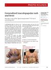 Generalized Maculopapular Rash and Fever in Systemic Lupus Erythematosus