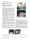 Body-Hair Transplant for Cicatricial Alopecia