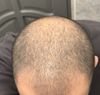 Question about finasteride