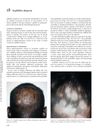 Syphilitic alopecia