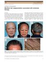 Manifest hair repigmentation associated with etretinate therapy