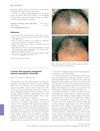 A woman with iatrogenic androgenetic alopecia responding to finasteride