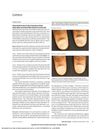 Tofacitinib Citrate for the Treatment of Nail Dystrophy Associated with Alopecia Universalis
