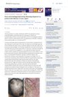 Rare and misdiagnosed entity fibrosing alopecia in a pattern distribution: A case report