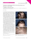 Permanent chemotherapy-induced nonscarring alopecia and premature ovarian failure