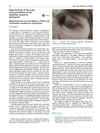 Hypertrichosis of the malar areas and poliosis of the eyelashes caused by latanoprost