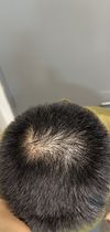 2 months into Minoxidil, poor sleep however, is it over for me?