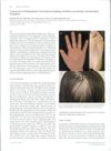 Concurrence of Palmoplantar Psoriasiform Eruptions and Hair Loss during Carbamazepine Treatment
