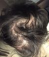 Completely obliterated my diffuse thinning without Finasteride w/ pictures