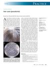 Hair casts (pseudonits)