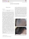 Spontaneous hair regrowth in eight patients with severe alopecia areata