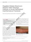 Flagellate Shiitake Mushroom Reaction With Histologic Features of Acute Generalized Exanthematous Pustulosis