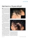 Hair loss in a 16-year-old girl