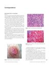Ductal breast cancer in a male patient