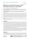 Reflectance Confocal Microscopy of Adult Periorificial Dermatitis: A Case Report