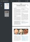 Sisaipho Alopecia Areata Treated With Tofacitinib and Oral Minoxidil