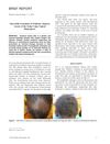 Successful Treatment of Pediatric Alopecia Areata of the Scalp Using Topical Bimatoprost