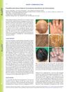 Propylthiouracil-induced Alopecia Accompanying Hypohidrosis and Onychomadesis