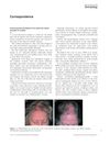 Erosive pustular dermatosis of the scalp from topical minoxidil 5% solution