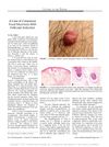 A Case of Cutaneous Focal Mucinosis With Follicular Induction