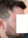 I&rsquo;ve always lacked a patch of hair, can it be fixed?