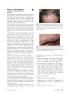 Reply to: Updated Diagnostic Criteria for Frontal Fibrosing Alopecia