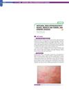 Urticaria, Drug Hypersensitivity Rashes, Nodules and Tumors, and Atrophic Diseases