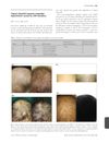 Topical minoxidil improves congenital hypotrichosis caused by <i>LIPH</i> mutations