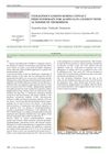 Vitiliginous Lesions During Contact Immunotherapy for Alopecia in a Patient with Autoimmune Thyroiditis