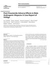 Post-Finasteride Adverse Effects in Male Androgenic Alopecia: A Case Report of Vitiligo