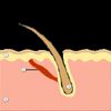 Physio-metabolic method of treating androgenic alopecia. Cold receptors. The relationship between DHT, cold receptors, minoxidil and antiandrogens