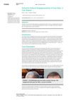 Acitretin-Induced Repigmentation of Gray Hair: A Case Report