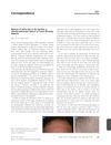 Absence of vellus hair in the hairline: a videodermatoscopic feature of frontal fibrosing alopecia