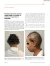 Rapidly progressive alopecia areata totalis in a COVID‐19 patient, unresponsive to tofacitinib