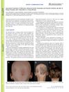 Successful Treatment of Refractory Alopecia Areata Universalis and Psoriatic Arthritis, But Not Plaque Psoriasis with Tofacitinib in a Young Woman