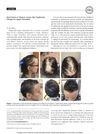 Reactivation of Alopecia Areata After Dupilumab Therapy for Atopic Dermatitis