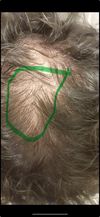 What should stop my thinning and falling of my hair