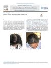 Clinical Course of Alopecia After COVID-19