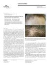 Clinical Description of Frontal Fibrosing Alopecia with Concomitant Lichen Planopilaris