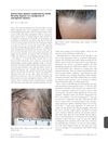 Discoid lupus alopecia complicated by frontal fibrosing alopecia on a background of androgenetic alopecia
