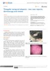 Triangular Temporal Alopecia - Two Case Reports, Dermoscopy and Review
