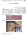 Chemotherapy-induced alopecia: A novel observation