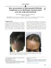 Rare presentation of disseminated follicular lymphoma as an ill-defined reticular patch over the scalp and forehead