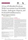 A Case of Folliculitis Decalvans With Concomitant Acne Keloidalis Nuchae, Androgenic Alopecia, and Profound Postinflammatory Hyperpigmentation